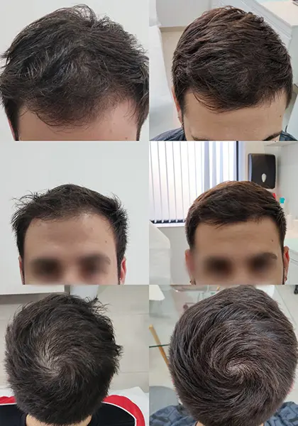 Tratamientos Clínica Mulet. Unidad capilar. Puerto de Sagunto (Valencia).