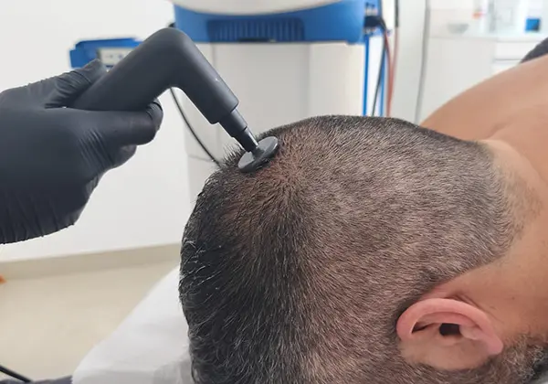 Tratamientos Clínica Mulet. Unidad capilar. Puerto de Sagunto (Valencia).